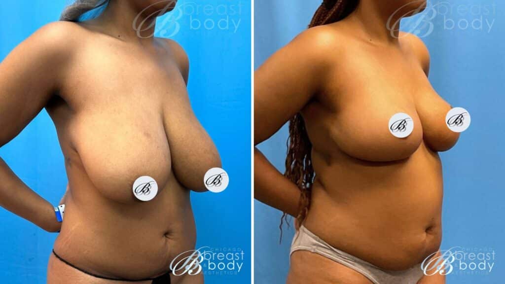 how much does breast reduction cost in chicago illinois