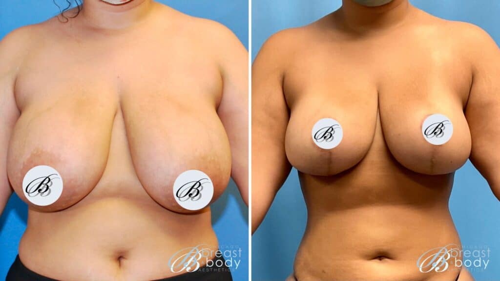 How much does breast reduction surgery cost in Chicago Illinois2