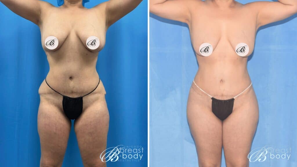 Revision BBL Before After Photo 821 Chicago Breast Body3