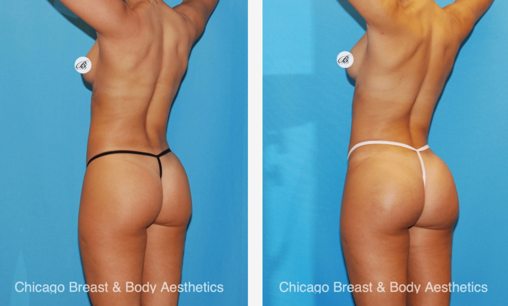 A woman's butt transformation showcased with before and after pictures, featuring 3 different types of BBL shapes for the perfect choice - Different Types of BBL