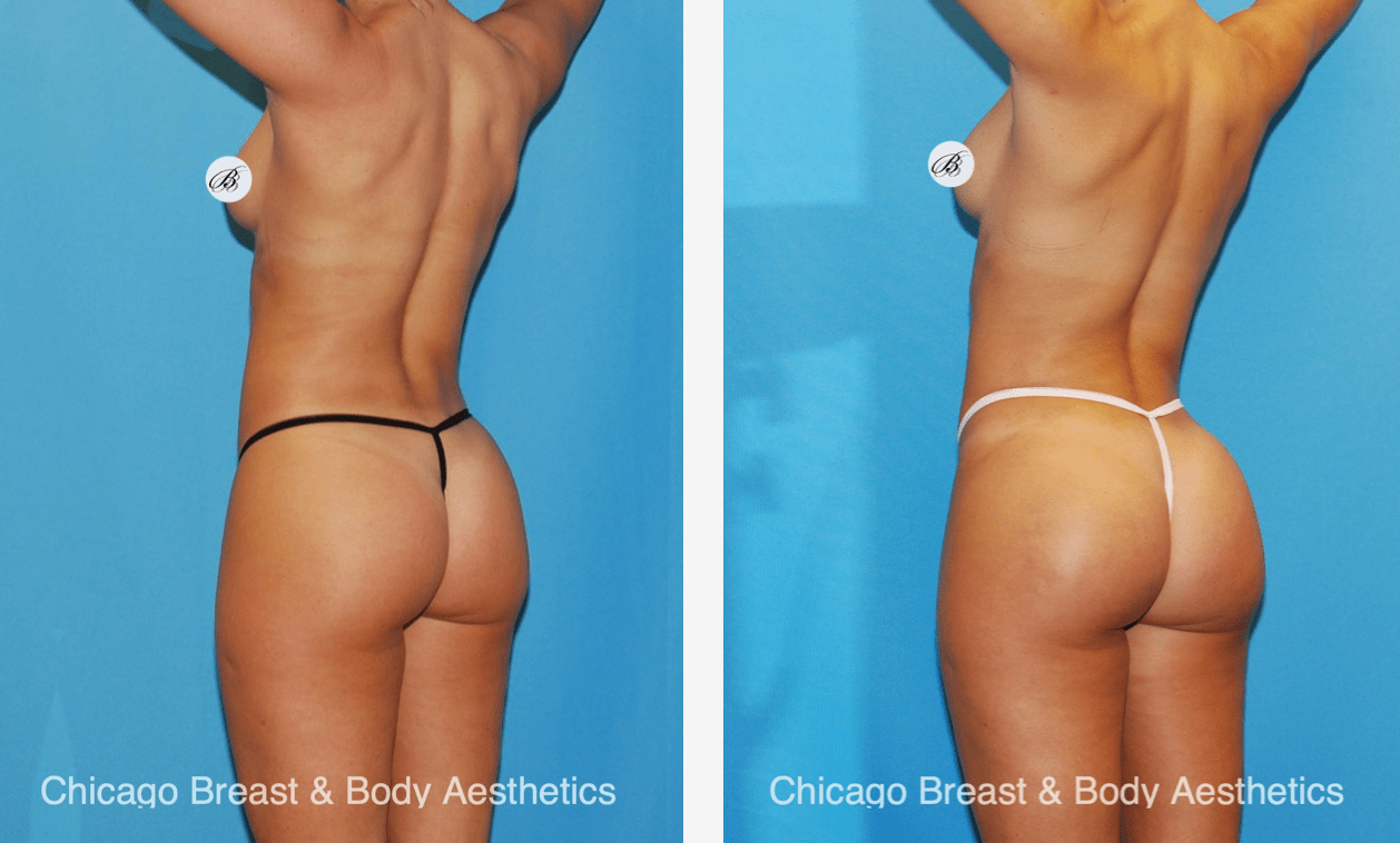 How a Brazilian Butt Lift Can Transform Your Body