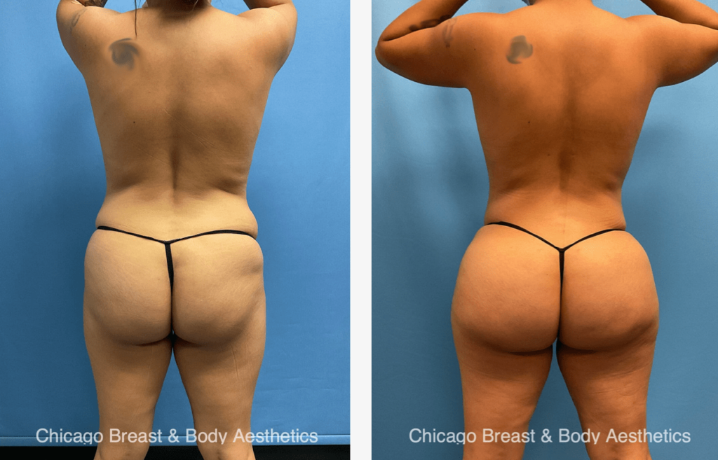 A woman's butt transformation after a body lift, showcasing different types of BBL shapes