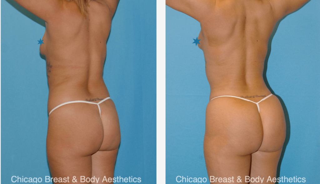 Before and after pictures of a woman's butt showcasing 3 different types of BBL shapes