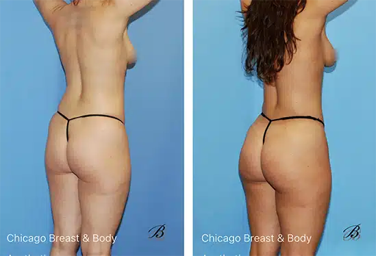 Skinny BBL Wish pics Chicago Breast and Body