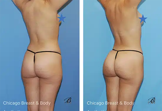 Skinny BBL Wish pics Chicago Breast and Body