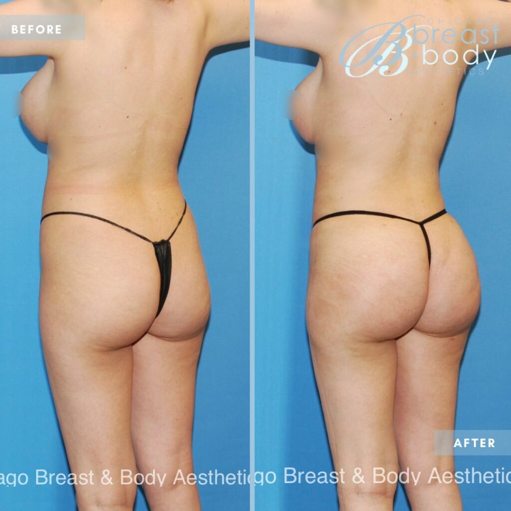 Ideal Age for Liposuction and BBL - Lipo360 BBL Before After Photo Chicago Breast And Body