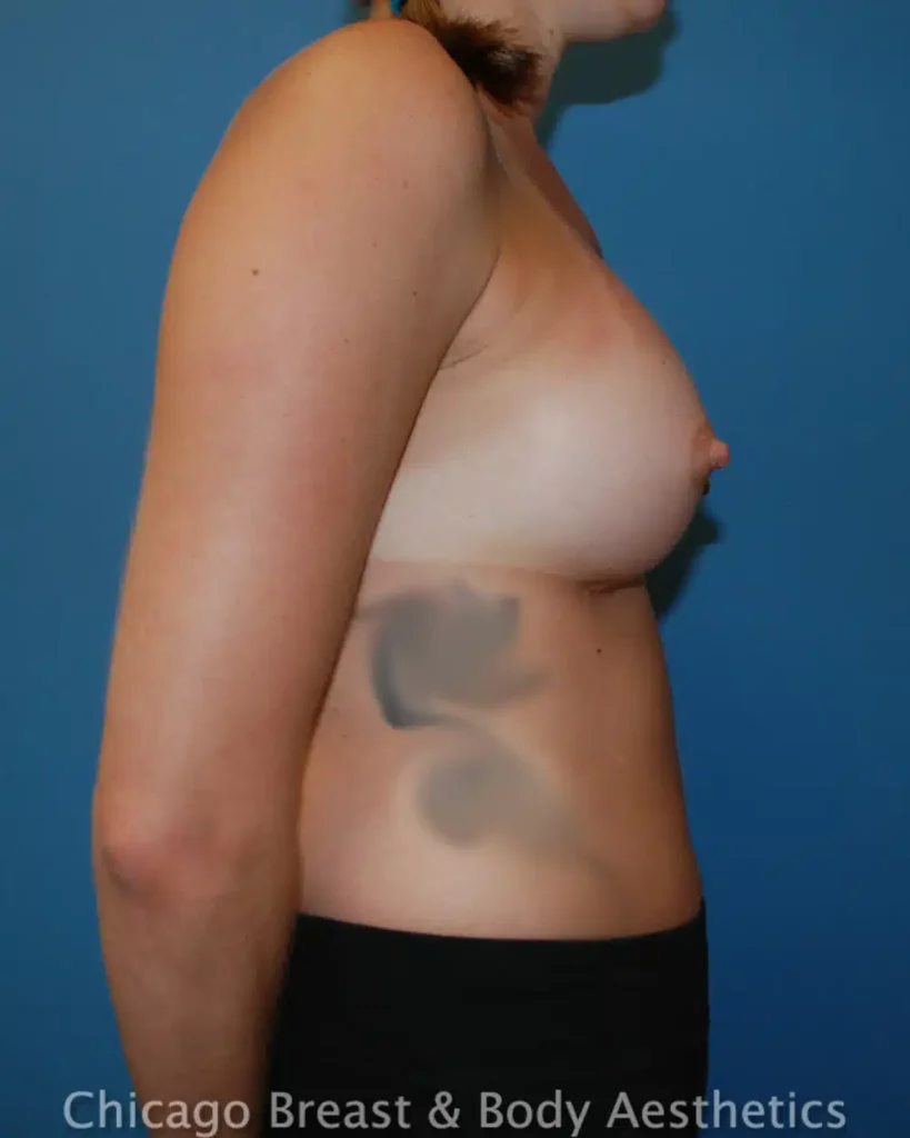 Chicago breast augmentation - breast implant surgery for enhancing the body.