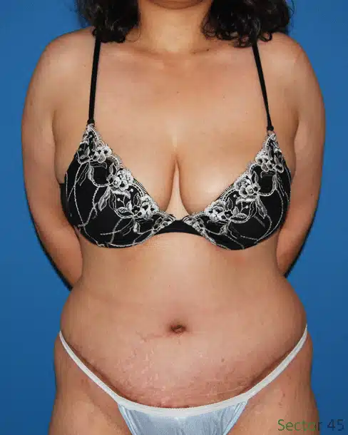 Dr. Anh-Tuan Truong performed a tummy tuck on a woman wearing a black bikini.