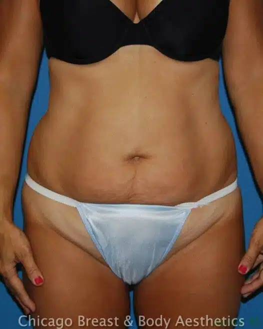 Tummy tuck before and after with Dr. Anh-Tuan Truong.