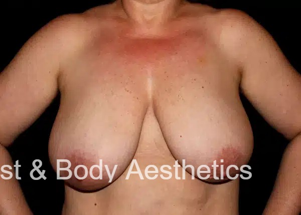 A woman with a large breast before and after breast augmentation.