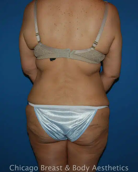 A woman in a bikini undergoing a tummy tuck procedure performed by Dr. Anh-Tuan Truong, Case # SEO keywords