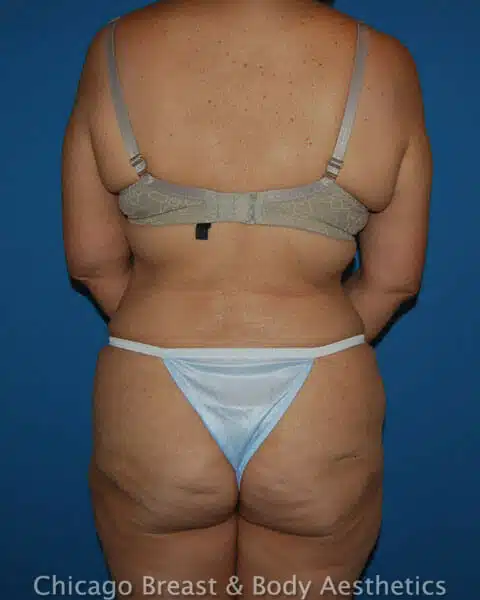 Case #1234: A woman with a tummy tuck bikini transformation, performed by Dr. Anh-Tuan Truong