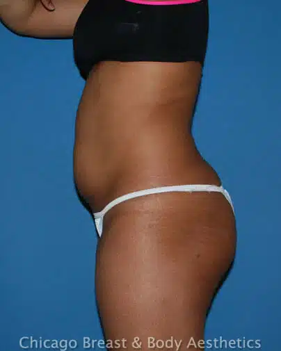 Liposuction before photo 2, case #98, Dr. Anh-Tuan Truong, Chicago Breast & Body