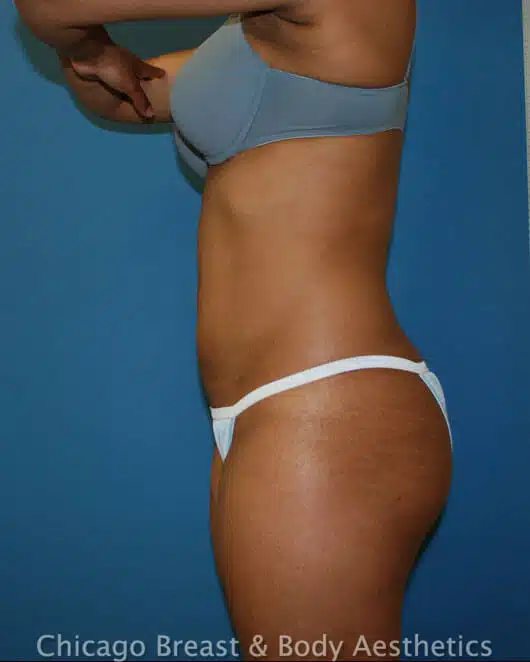 Liposuction after photo 2, case #98, Dr. Anh-Tuan Truong, Chicago Breast & Body