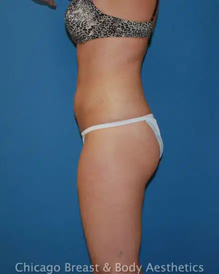 Case #137 in Chicago undergoes Smartlipo tummy tuck for breast and body enhancement.