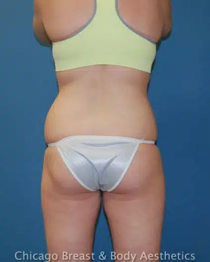A woman with a bikini-ready figure after a tummy tuck case.