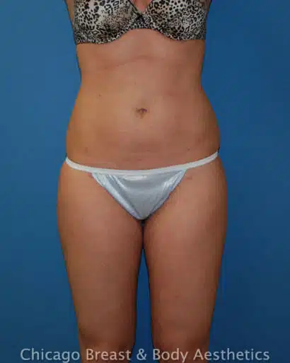 A woman's tummy before and after Smartlipo.