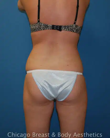 The back view of a woman in a white bikini undergoing Smartlipo procedure (Case #137).