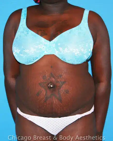 A woman in a blue bikini with a Full Tummy Tuck.