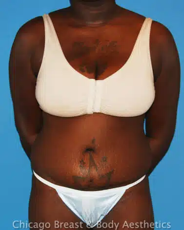 A woman in a white bikini with a full tummy tuck.