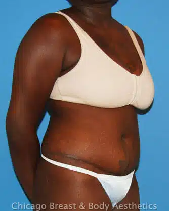 A woman in a bikini flaunting her full tummy tuck.