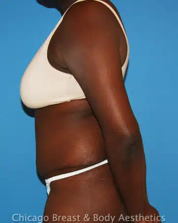A woman with a Full Tummy Tuck, Case #157, confidently flaunts her bikini-ready body.