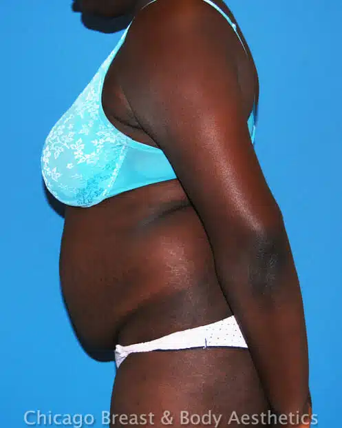 A woman with a blue bikini, showcasing her tummy tuck transformation.