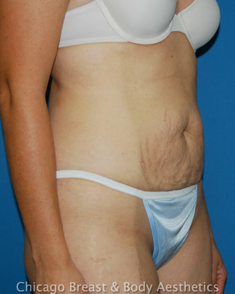 Dr. Anh-Tuan Truong's liposuction case on a woman's tummy.