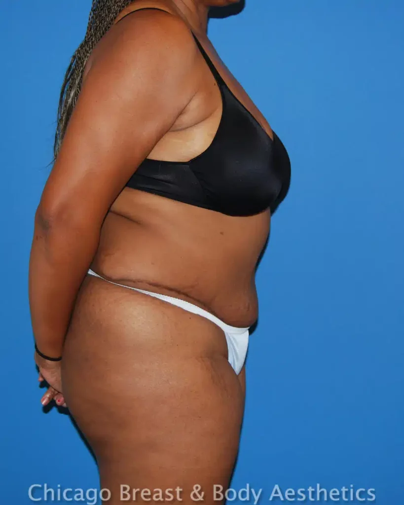 A woman with a tummy tuck in a bikini. (Keywords used: Full Tummy Tuck)