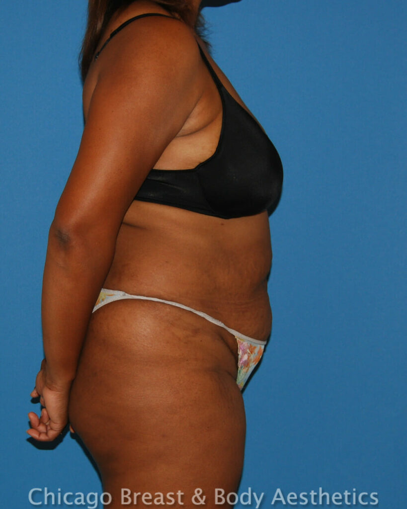 A woman with a Full Tummy Tuck (Case # 196) posing in a bikini.