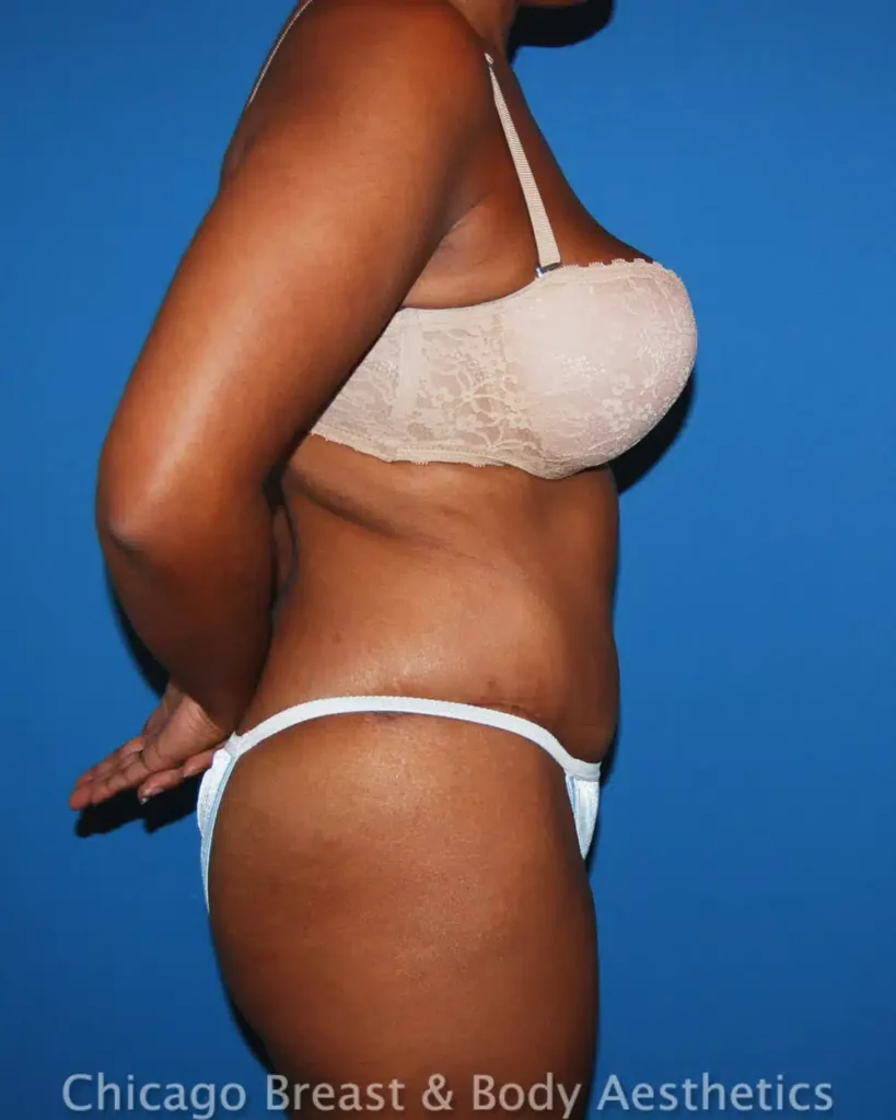 Case 247 showcases a woman in a bikini confidently displaying the transformative results of her tummy tuck.