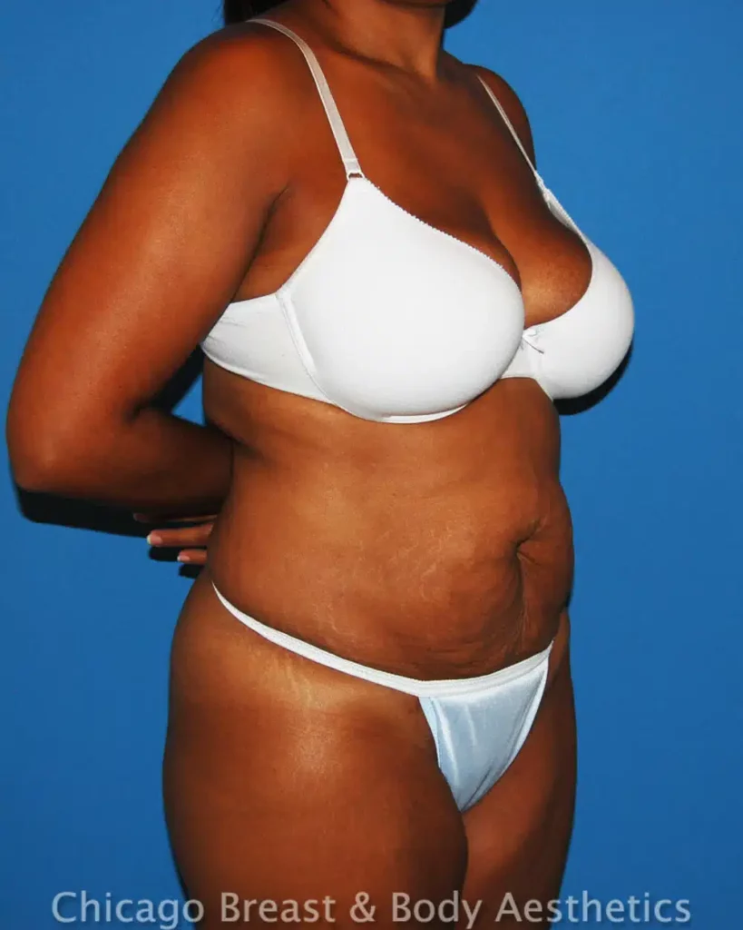 See Chicago breast & body transformations with before and after images. Check out impressive results of full tummy tuck surgeries in our case # collection.