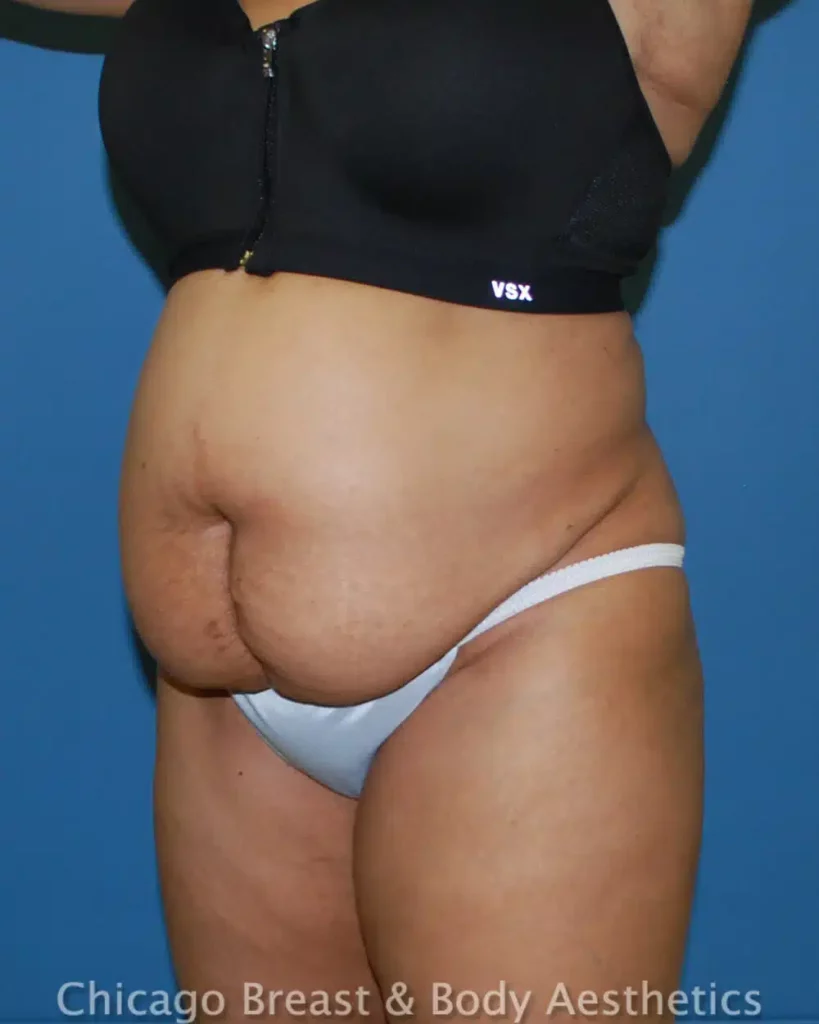 Dr. Anh-Tuan Truong performed a tummy tuck procedure on a woman wearing a black bikini at case #340.