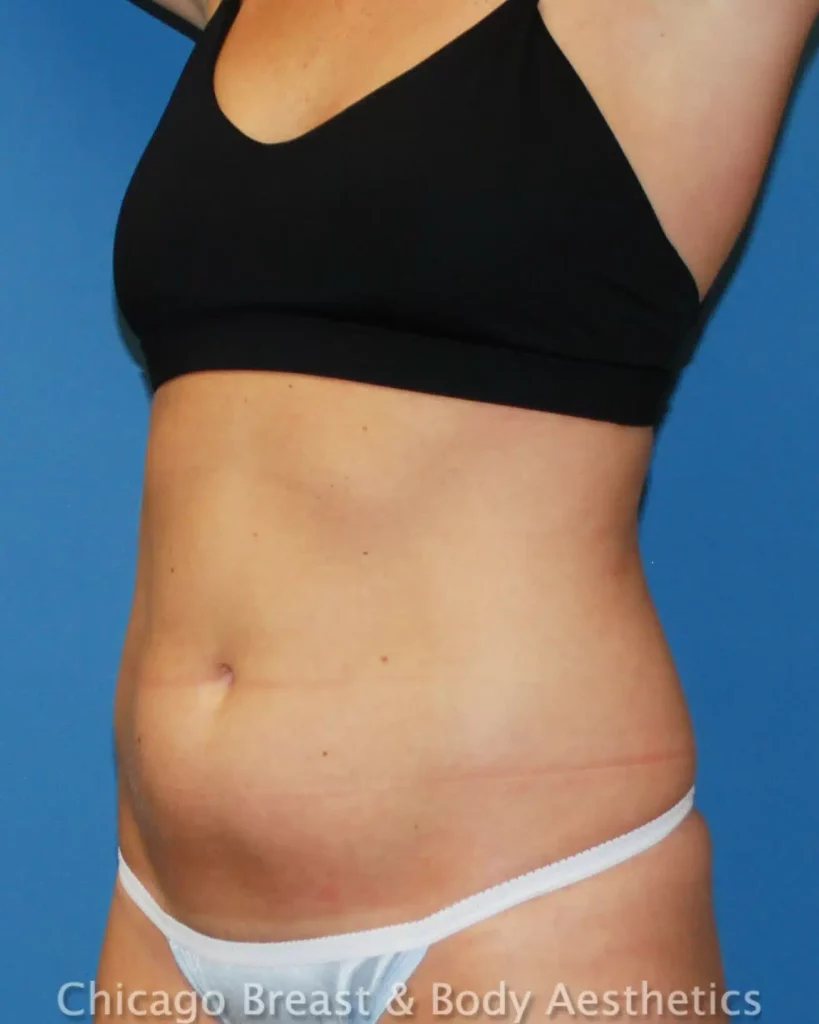 Case #299 showcases the remarkable results of Smartlipo on a woman's tummy.