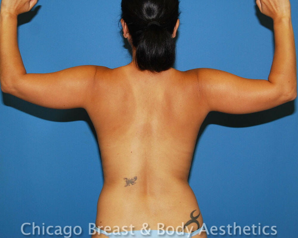 Chicago breast & body aesthetics - back view. Case #454.