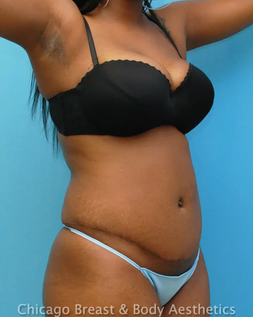 Chicago breast & body tummy tuck combines full body sculpting and a specialized case for achieving desired results.
