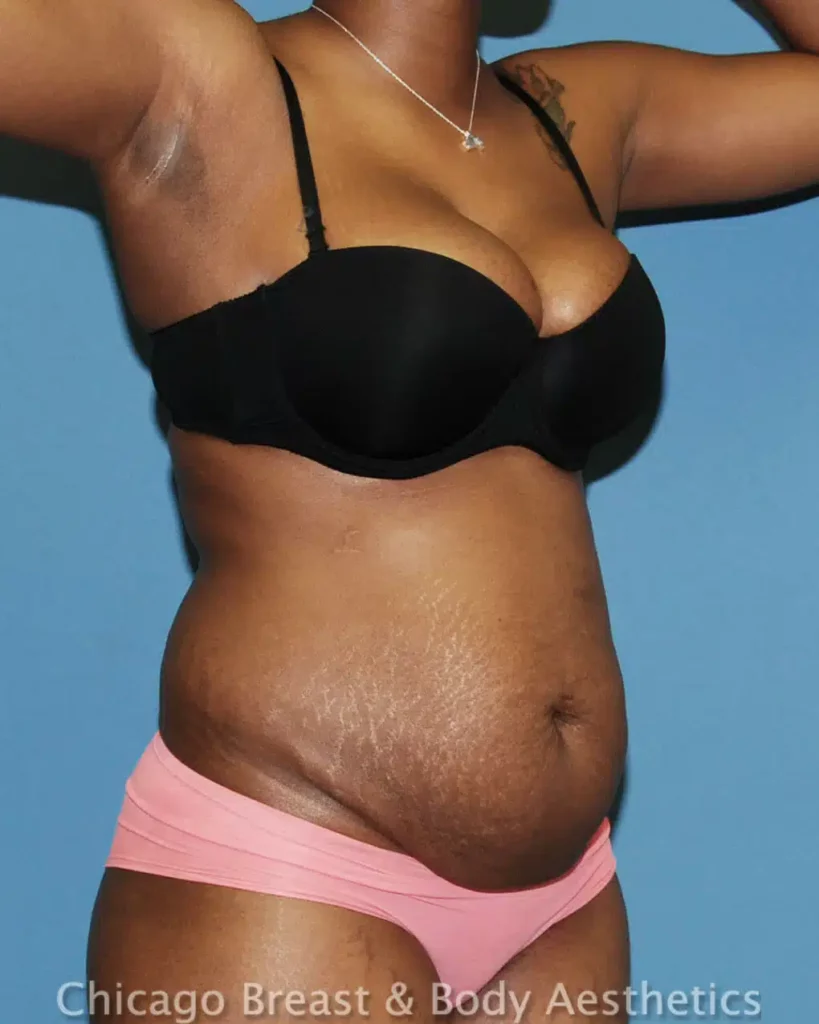 Chicago breast & body aesthetics - patient image 1 - Full Tummy Tuck.