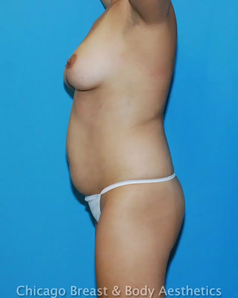 A woman in a bikini showcasing the results of a tummy tuck procedure using Smartlipo. (Case #495)