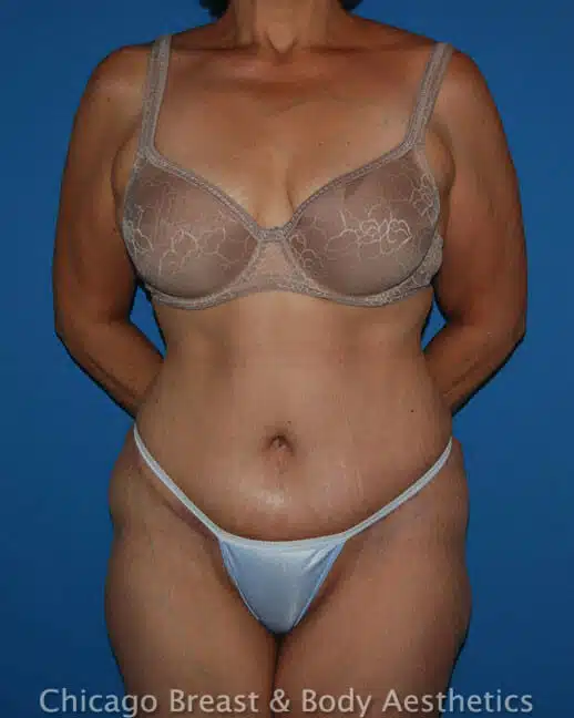 Dr. Anh-Tuan Truong specializes in tummy tuck procedures for the breast and body in Chicago.
