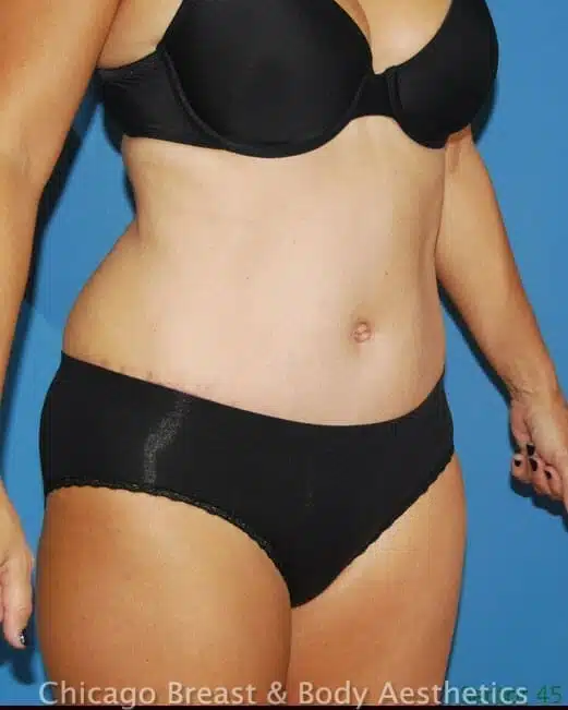 Dr. Anh-Tuan Truong's Chicago breast & body tummy tuck, Case #24.