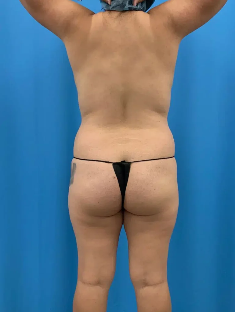 1213 Brazilian Butt Lift Lin 3mos