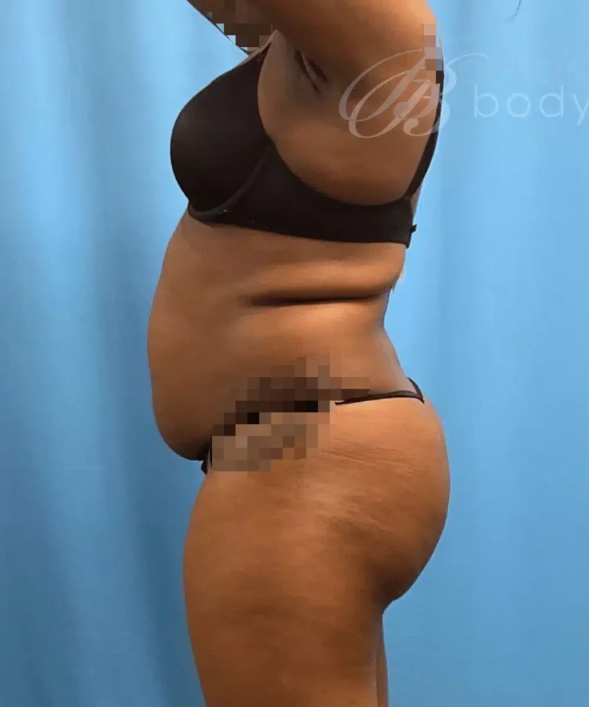 A woman in a bikini with a tummy tuck performed by Dr. Kevin Lin.