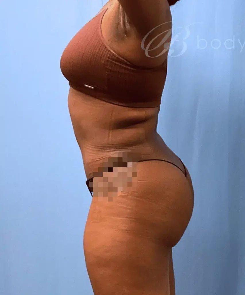 A woman in a bikini undergoing a tummy tuck performed by Dr. Kevin Lin.