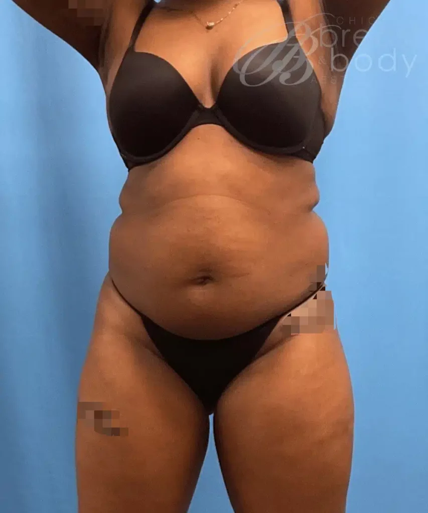 A woman in a black bikini after receiving a tummy tuck from Dr. Kevin Lin.