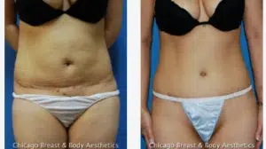 Check out the amazing transformation of Case #204 after a Full Tummy Tuck.
