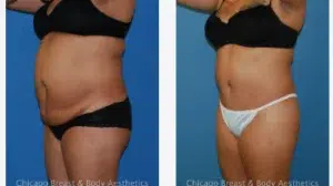 Tummy tuck before and after chicago breast and body