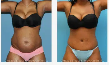 Full Tummy Tuck transformation - Case #480. View stunning before and after results.