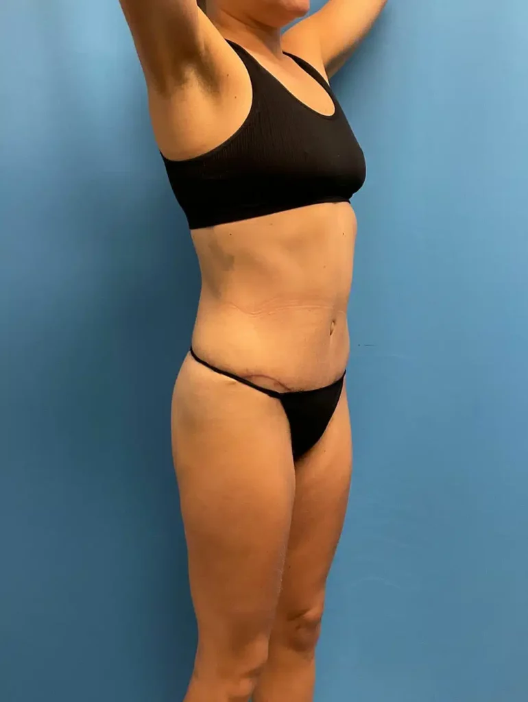 A woman in a black bikini post-tummy tuck procedure performed by Dr. Kevin Lin.
