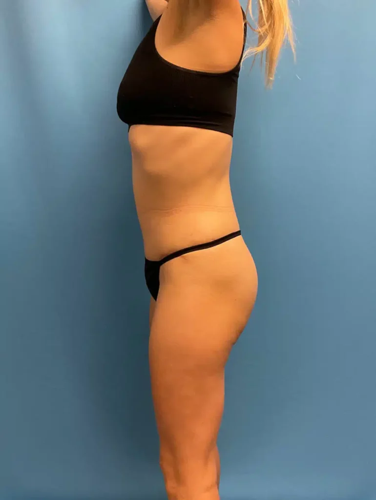 A woman in a black bikini with a tummy tuck performed by Dr. Kevin Lin (Case #4120).