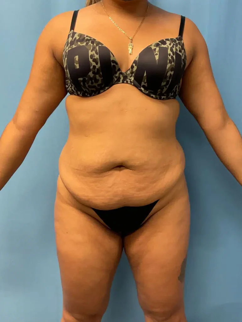 Tummy Tuck before and after photo by Dr. Kevin Lin. Case #701